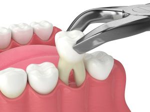 Illustration of a tooth extraction using dental forceps.